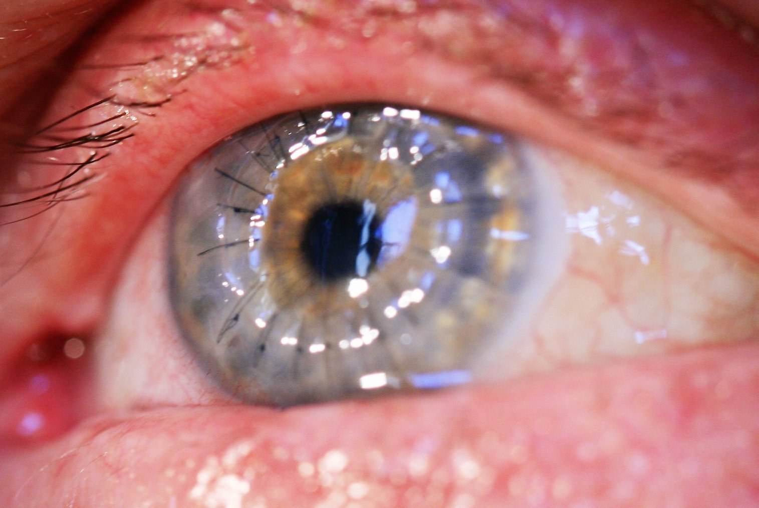 Corneal transplant