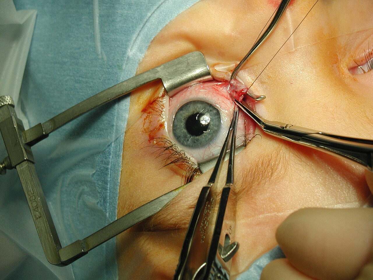 Desinsertion du muscle CO Strabismus surgery—medial rectus muscle being disinserted following pre-placement of vicryl sutures. Public Domain.