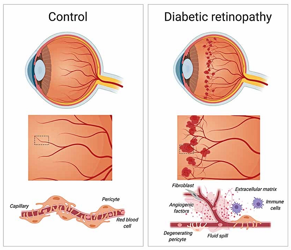 Diabetic retinopathy Diabetic retinopathy