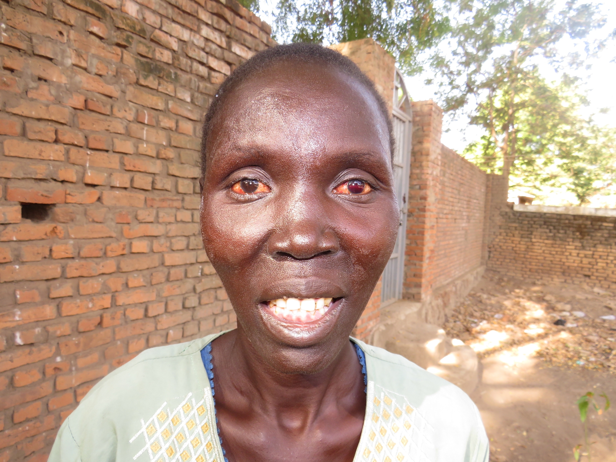 This 35-year-old mother in South Sudan was abandoned by her husband after she became blind.