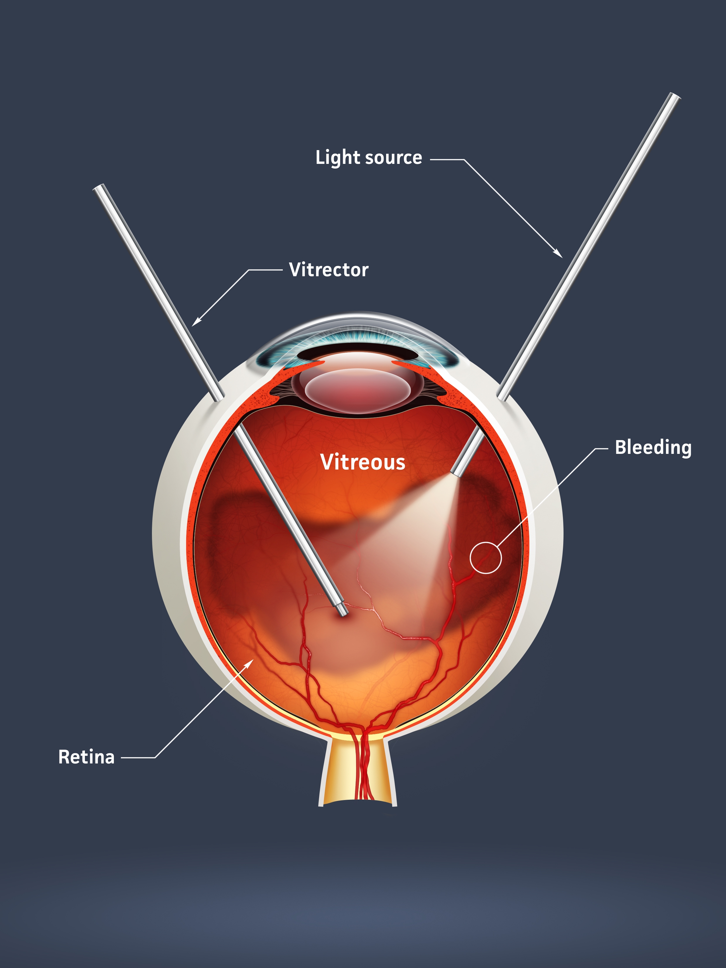 Diabetic retinopathy diagram Diabetic retinopathy diagram