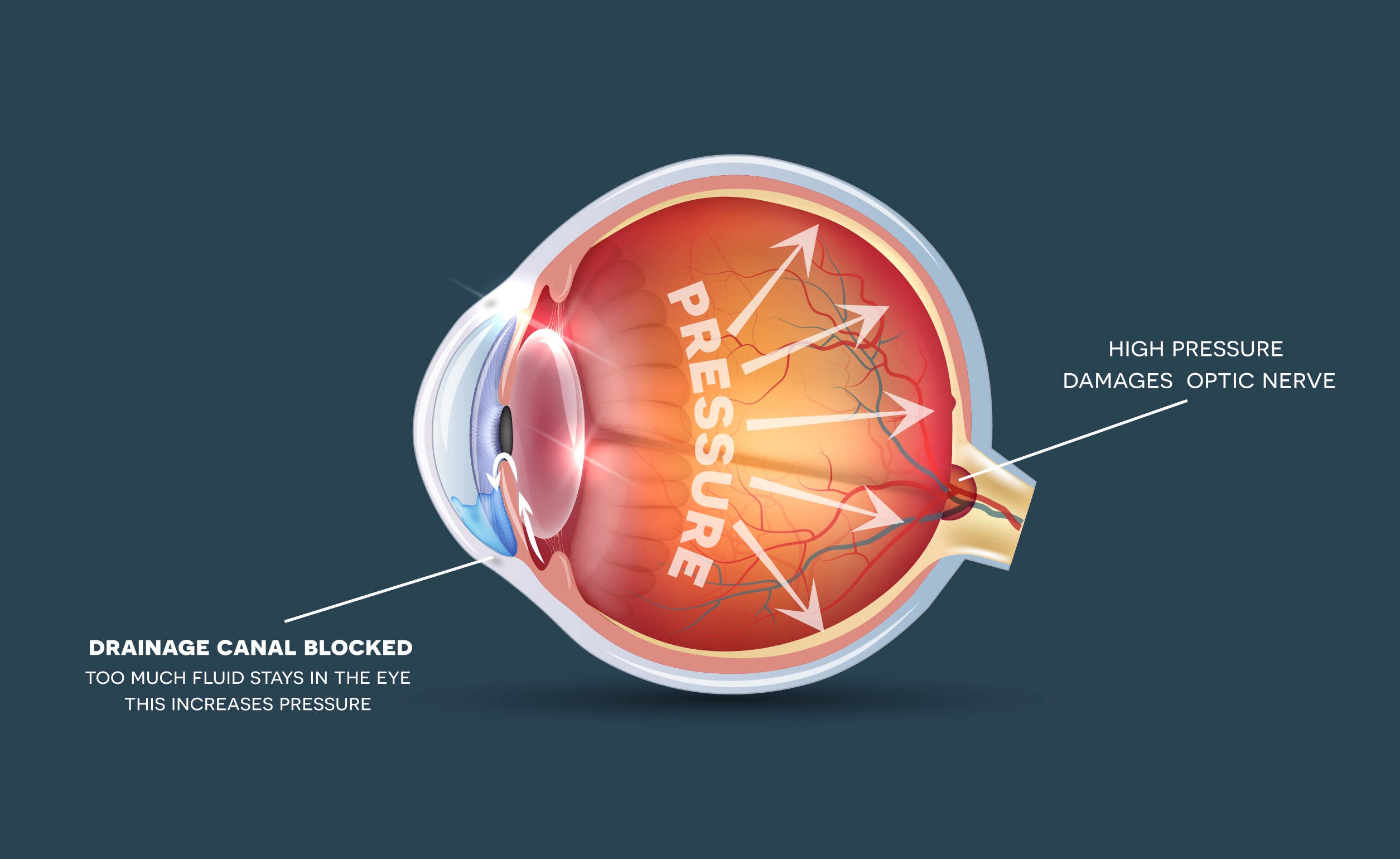 Glaucoma diagram brand Glaucoma diagram brand