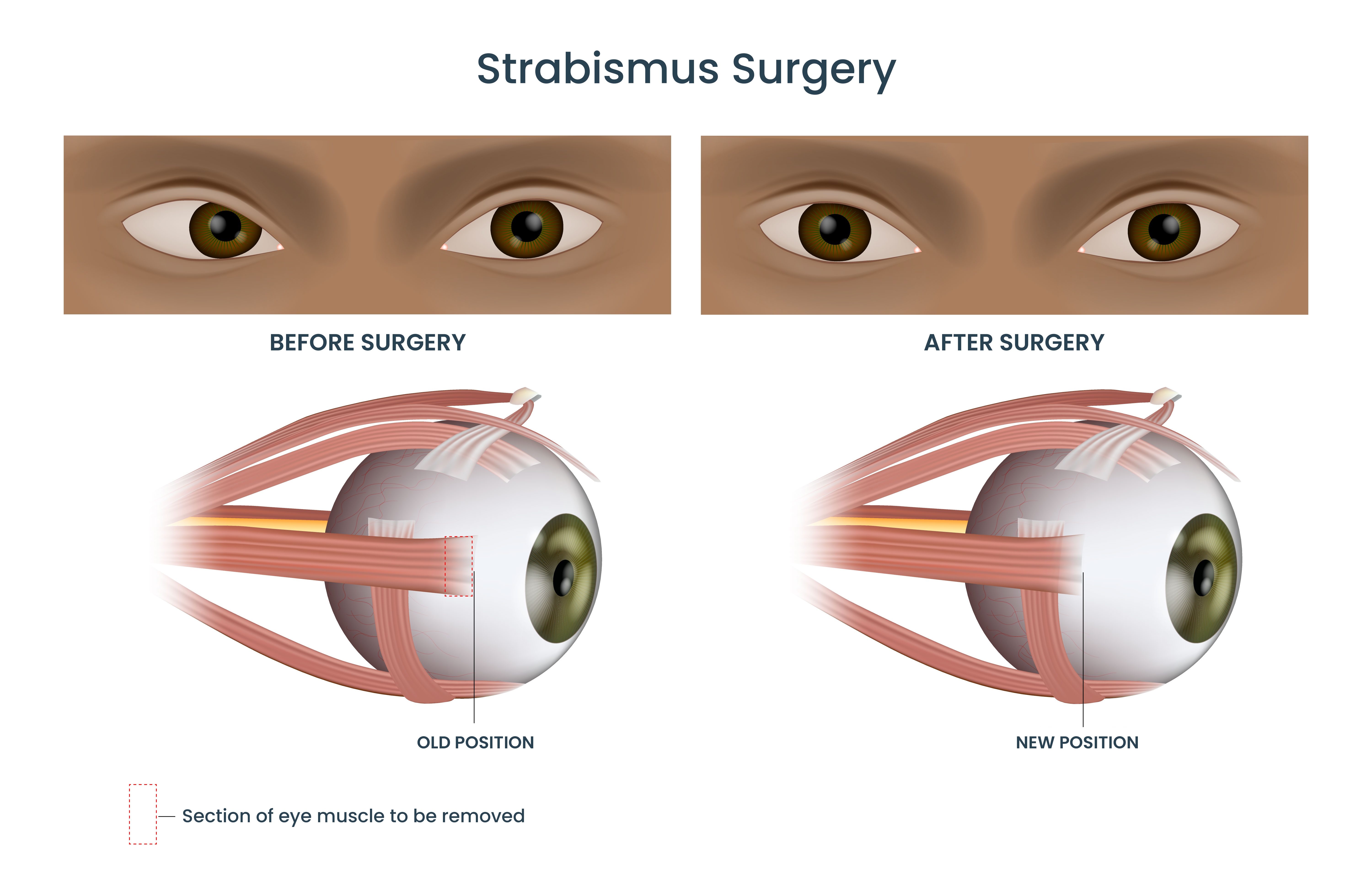 Strabismus surgery Diagram of the human eye showing section of muscle that may be removed in strabismus surgery.