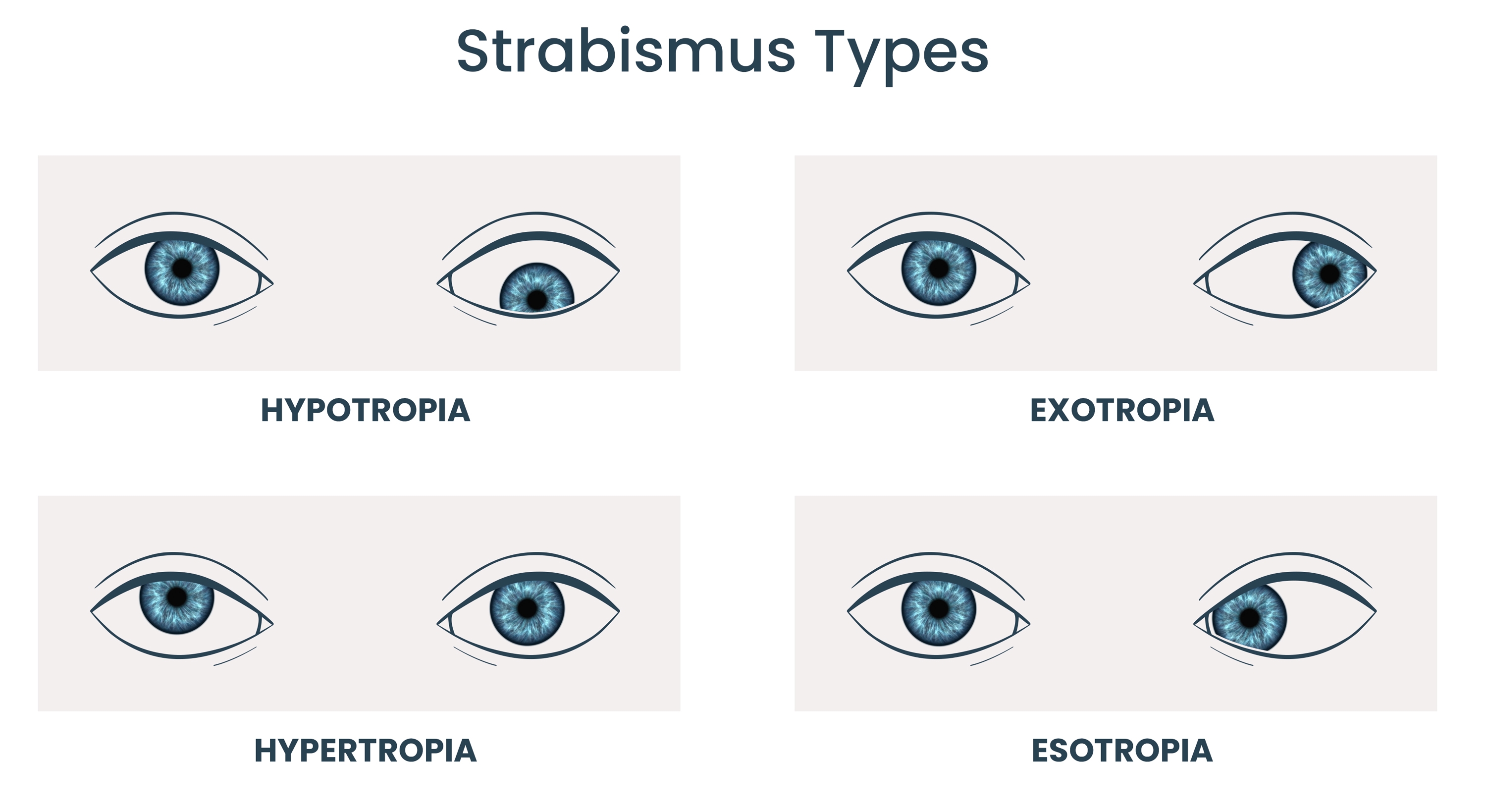 Strabismus types Types of strabismus: Hypotropia, Hypertropia, Exotropia, Esotropia